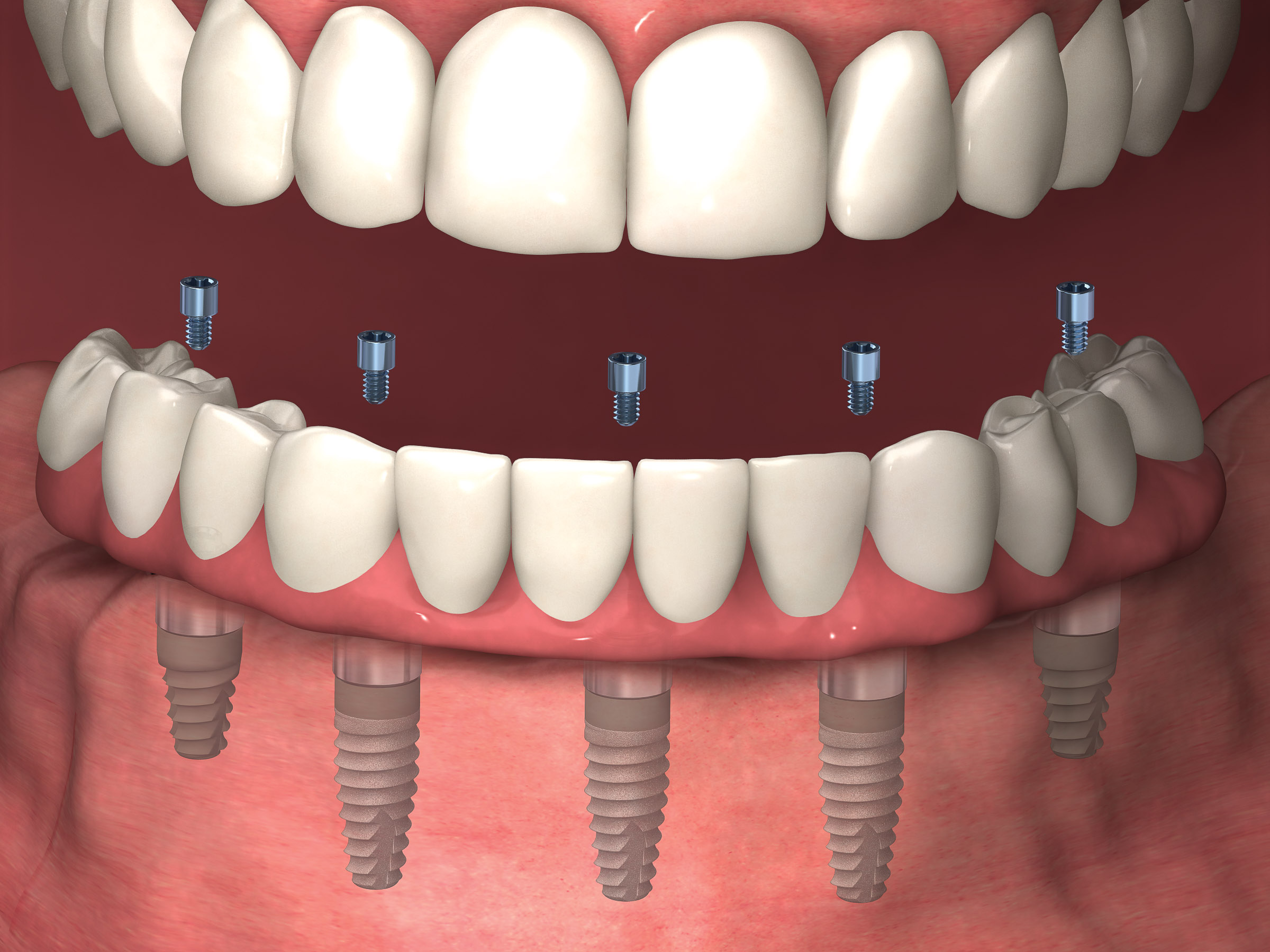 Multiple Teeth Replacement